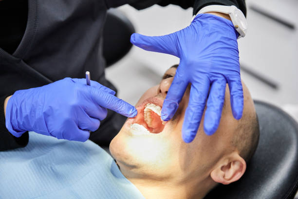 Best Emergency Wisdom Teeth Removal in Annapolis, MD